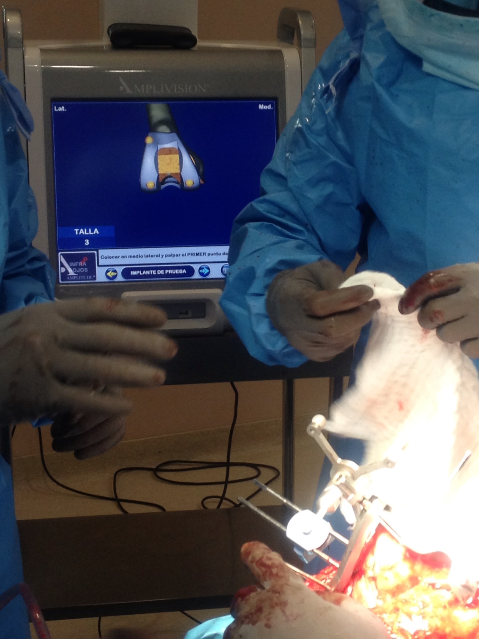 Prótesis Rodilla Navegada